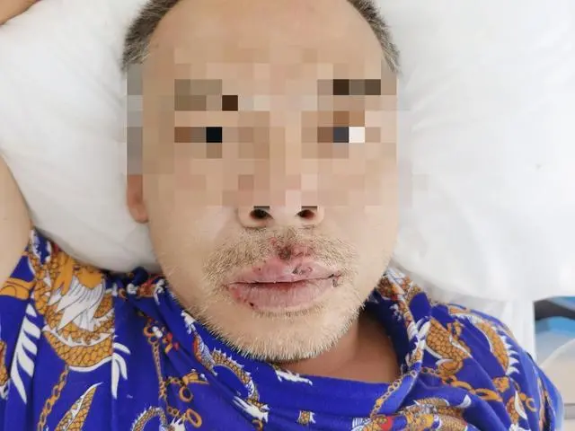 猪“热死”了低价出售？湖南一男子买回炼油，结果全身剧痛差点没命