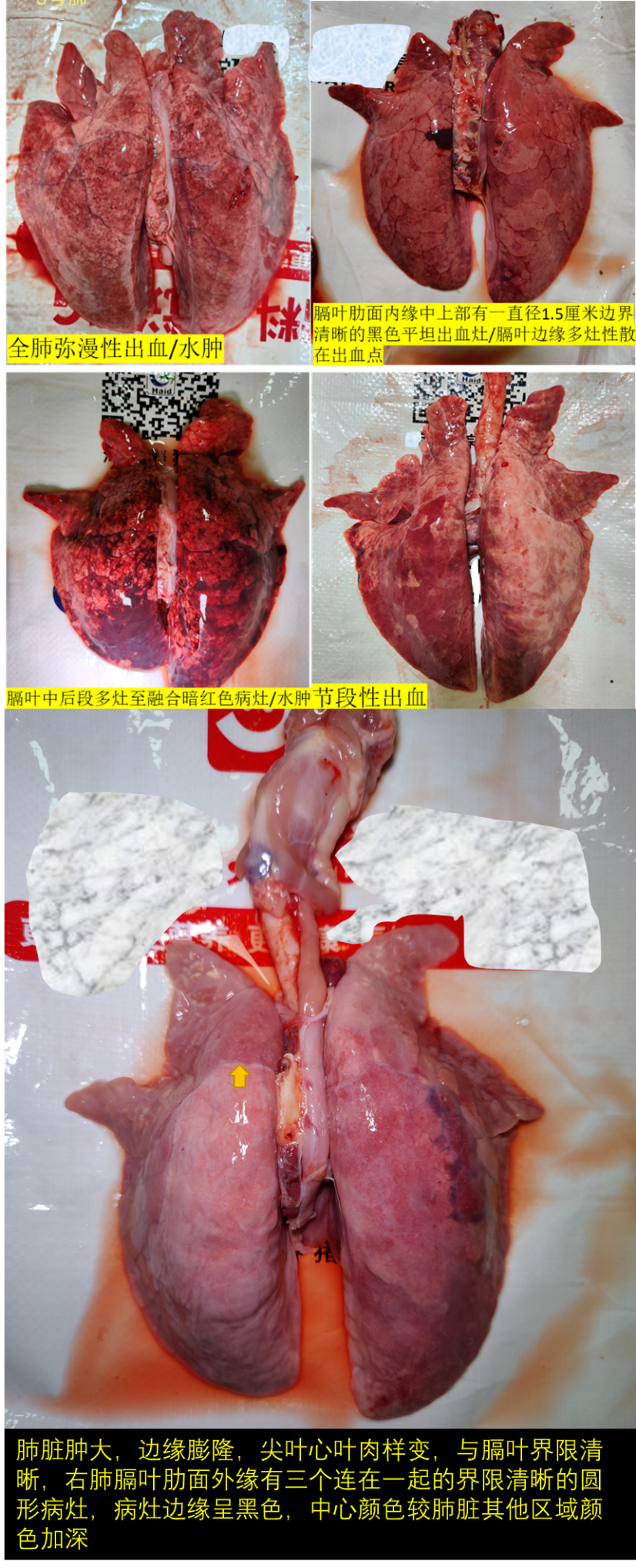 肝凝固性坏死图片图片