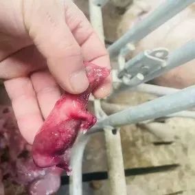 怀孕中前期流产