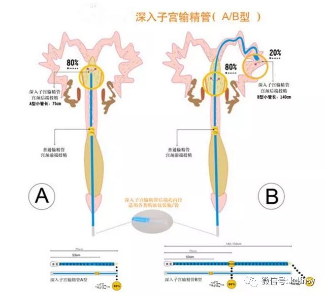 深入子宫输精管