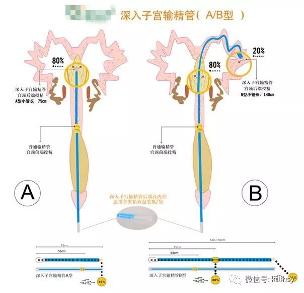 普通输精和深部输精技术对比