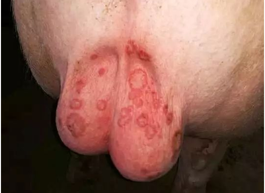 玫瑰糠疹是病毒还是真菌感染？偏方治怪病！