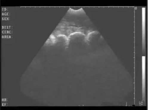 △显示膀胱前方的子宫角区域声像图